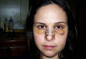 Ушиб носа: как быстро вылечить опухоль