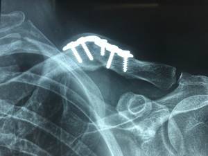 Перелом плечевой кости руки: лечение, срок срастания, операция с пластиной, реабилитация