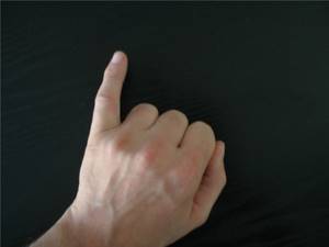 Перелом мизинца на руке: симптомы, сколько заживает