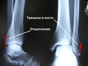 Трещина в кости на ноге и руке: симптомы, лечение