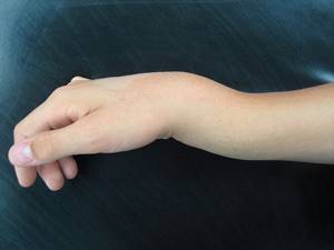 Перелом руки: признаки, симптомы, лечение