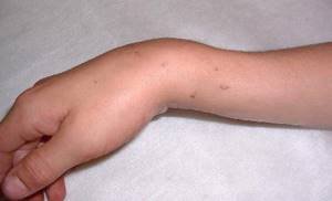 Перелом лучевой кости руки со смещением: лечение, срок срастания