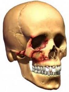 Перелом верхней челюсти: симптомы, лечение