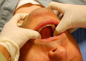 Вывих челюсти: симптомы и лечение
