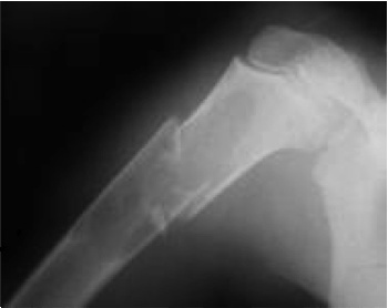 Патологические переломы костей Патологический перелом: что это?