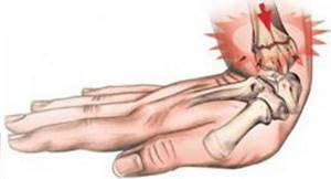 Перелом кисти руки: симптомы, лечение, сколько дней гипс