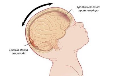 Сотрясение мозга у взрослых и детей: причины, симптоматика, лечение