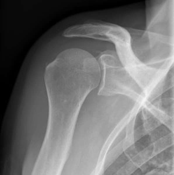 Перелом большого бугорка плечевой кости