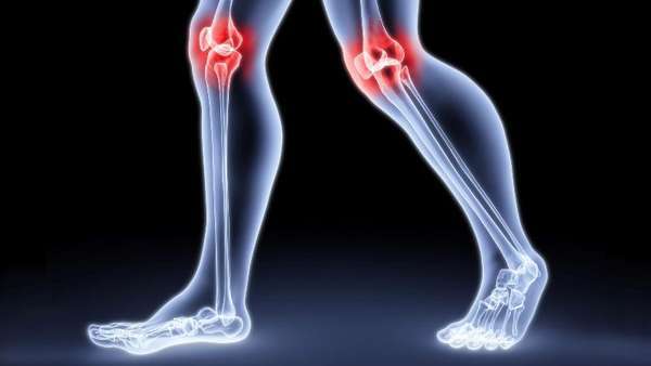 Вывих коленного сустава: лечение в домашних условиях