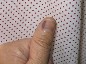 Ушиб ногтя на руке и ноге: что делать в домашних условиях