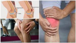 Перелом надколенника (коленной чашечки): лечение, последствия, реабилитация
