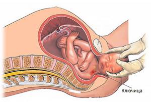 Перелом ключицы у новорожденного при родах