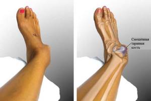 Перелом ноги: признаки, сколько ходить в гипсе