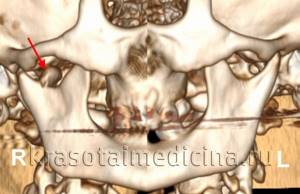Перелом нижней челюсти: лечение, классификация