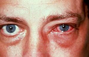 Ожог глаза: первая помощь, последствия, лечение