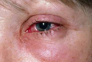 Ожог глаза: первая помощь, последствия, лечение