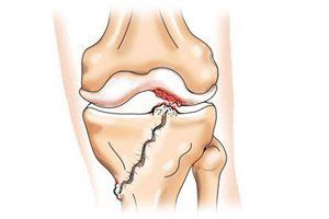 Ушиб колена при падении: лечение в домашних условиях