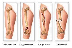 Трещина в кости на ноге и руке: симптомы, лечение
