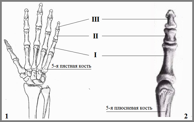 Перелом мизинца на руке: симптомы, сколько заживает
