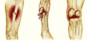 Перелом ноги: признаки, сколько ходить в гипсе