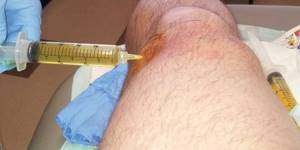 Синовит коленного сустава: симптомы, лечение, диагностика, классификация