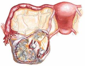 Дермоидная киста яичника: причины, лечение, симптомы, операция, возможность беременности