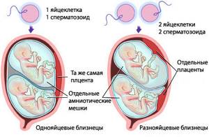 Беременность двойней: признаки, диагностика, осложнения