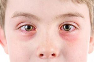 Аллергический конъюнктивит: лечение, симптомы