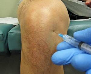 Скрипящие колени - признак остеоартроза