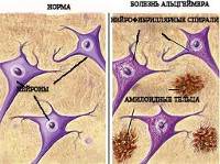 Симптомы болезни Альцгеймера, диагностика и лечение