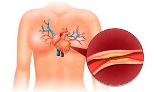 Атеросклеротический кардиосклероз: лечение, симптомы, причины, профилактика