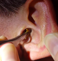 Серная пробка в ухе: симптомы, можно ли удалить в домашних условиях