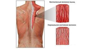 Симптомы и лечение миозита мышц шеи, спины, бедра, грудной клетки, плеча