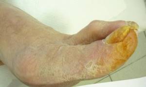 Атеросклероз сосудов ног: лечение, симптомы