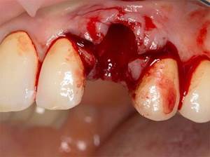 Болит зуб: виды боли, причины боли после лечения, удаления, болит десна
