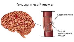 Геморрагический инсульт симптомы, лечение, последствия для головного мозга