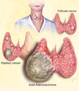 Рак щитовидной железы - симптомы, лечение, стадии