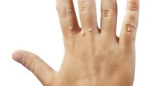 Бородавки на руках и пальцах - лечение, удаление, выведение