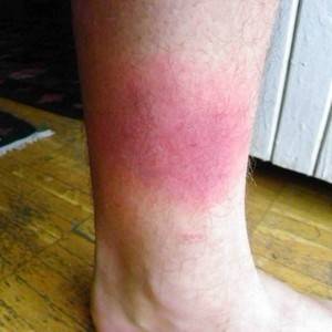 Красные пятна на ногах: причины, почему появляются