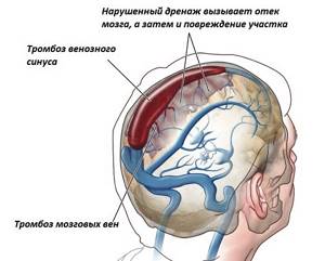 Тромб в голове: симптомы, лечение, последствия тромбоза сосудов головного мозга