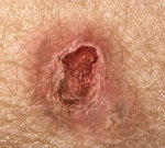 Рак кожи: признаки, симптомы, лечение