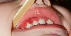 Кровоточат десны: что делать, причины постоянной кровоточивости десен при чистке зубов, лечение в домашних условиях