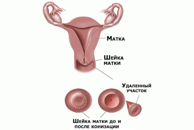 Рак шейки матки: симптомы, лечение, анализы, диагностика, рецидив