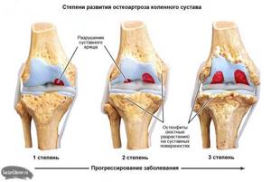 Скрипящие колени - признак остеоартроза