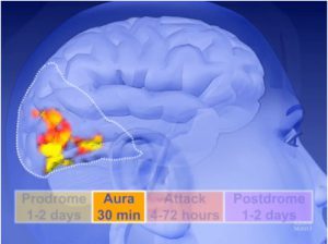 Что такое мигрень: признаки мигрени с аурой