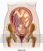 Узкий таз: клинически и анатомически, степени, таблица, ведение родов, кесарево сечение