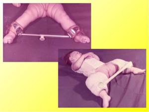 Дисплазия тазобедренного сустава у новорожденного ребенка