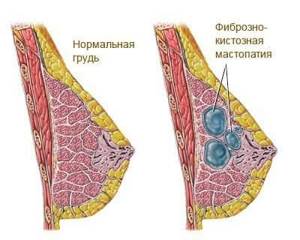 Фиброзно-кистозная мастопатия: лечение, симптомы, причины, диагностика