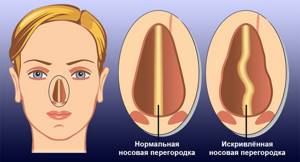 Искривление носовой перегородки: операция, лечение, причины, симптомы