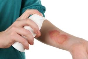 Химический ожог кожи: лечение, первая помощь в домашних условиях